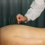 acupuncture