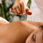 licensed acupuncturist performing immune support acupuncture on a patient